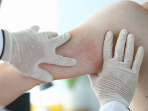 Read more about the article When is a drug rash more than just a rash?